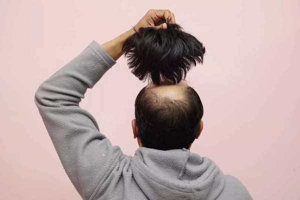 Cosmetic Hair Systems